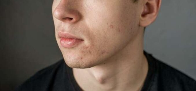 What You Need To Know About Hormonal Acne